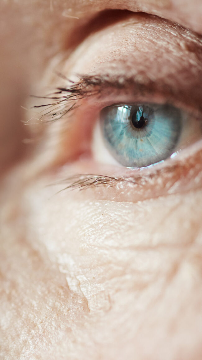 PATHOLOGIE_VUE_Glaucome_story